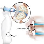 Facet Joint Pain