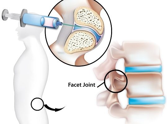 Facet-joint-pain