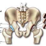 Hip Pain (Osteoarthritis)