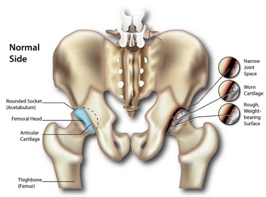 Hip arthritis osteoarthritis