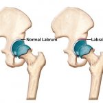 Hip Labral Tear