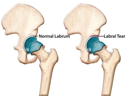 hip labral tear