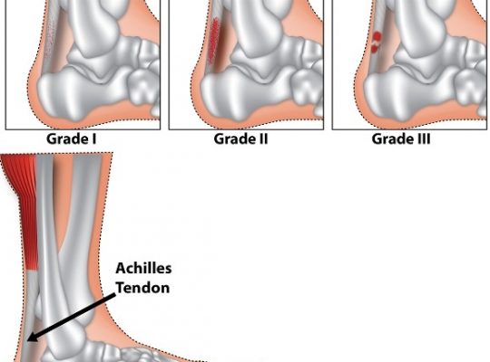 Achilles-tendonitis-tendinitis