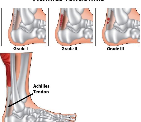 Achilles-tendonitis-tendinitis