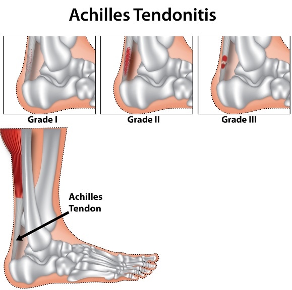 Achilles Tendinitis - Causes, Symptoms and Treatments | SportNova UK