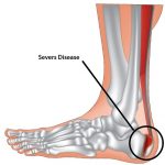 Sever’s Disease (Heel Pain)