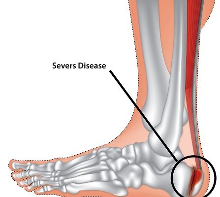 Sever's disease