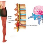 Sciatica