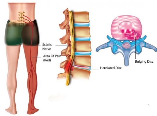 sciatica