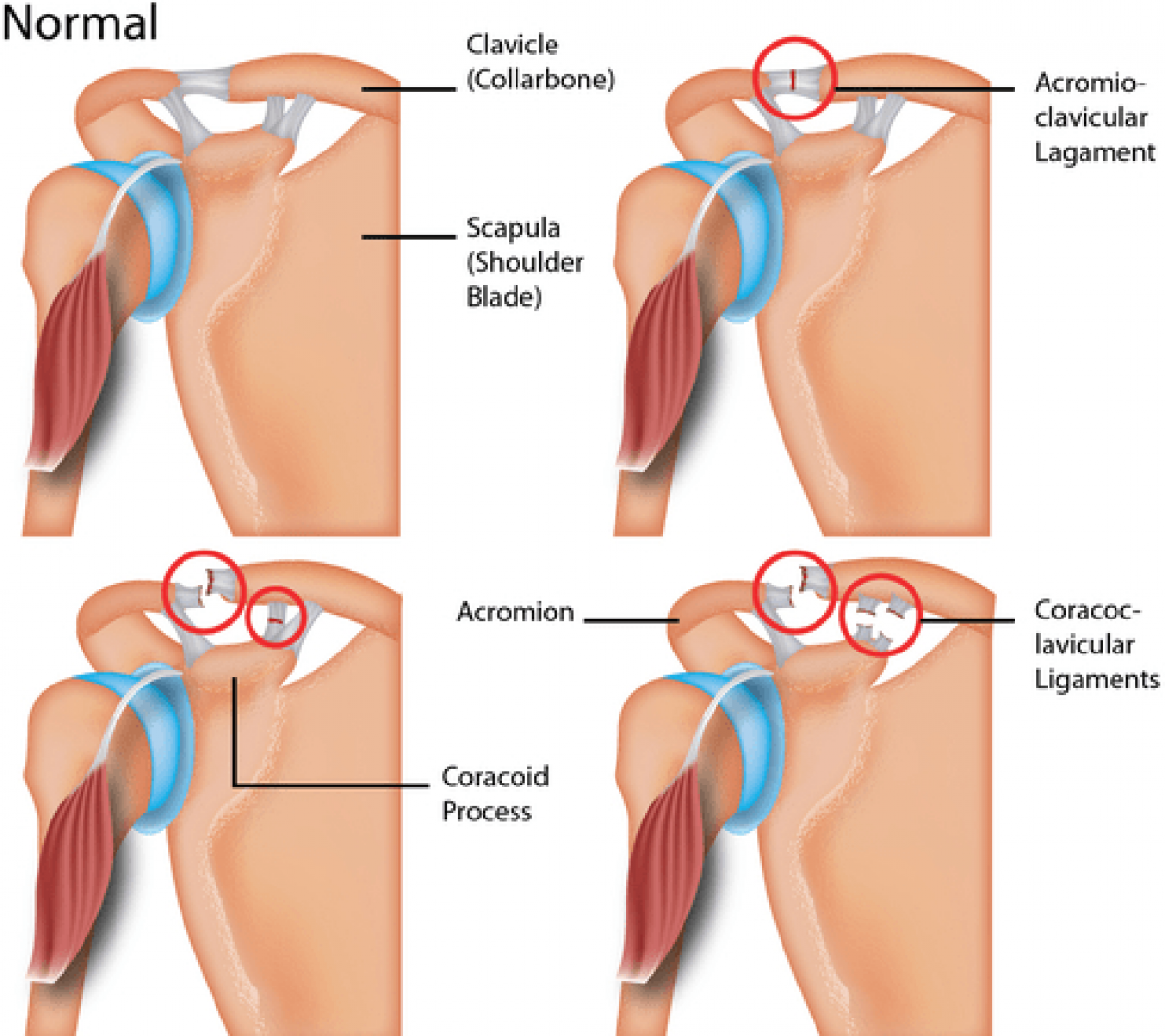 Acromioclavicular Joint Ligaments