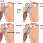 Acromioclavicular Joint Injury
