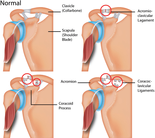 ac joint injury