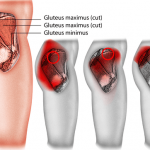 Gluteal Tendinopathy