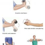Tennis Elbow (Lateral Epicondylitis)
