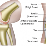 Patellar Tendinopathy