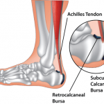 Retrocalcaneal Bursitis